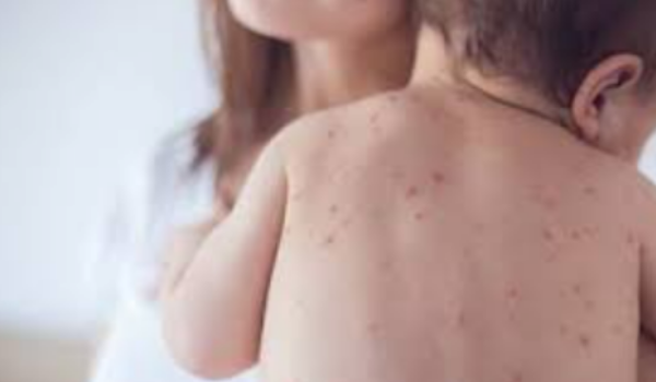 Measles Disease Symptoms, Caused By, Vaccine, Cases right now
